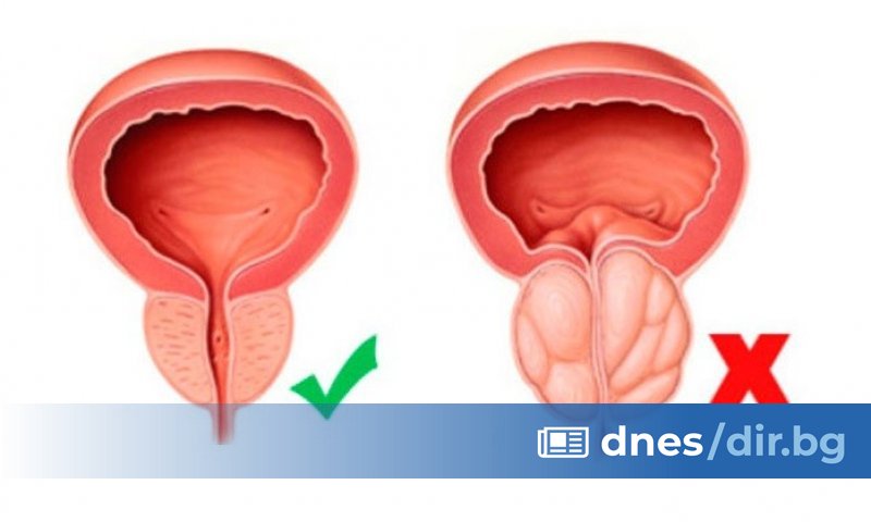 Проблемите с уринирането са ежедневие за голяма група от мъжете