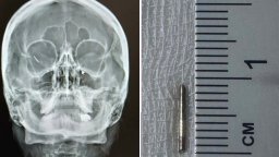 Спешна операция спаси зрението на млада жена с част от шнола в окото