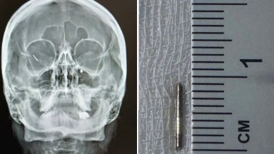 Спешна операция спаси зрението на млада жена с част от шнола в окото
