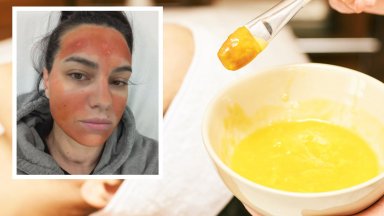 Млада жена е със сериозни изгаряния след процедура в салон за красота в София