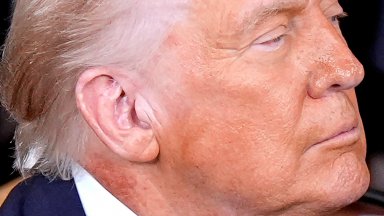Тръмп е подложен на лечение заради червен обрив на врата